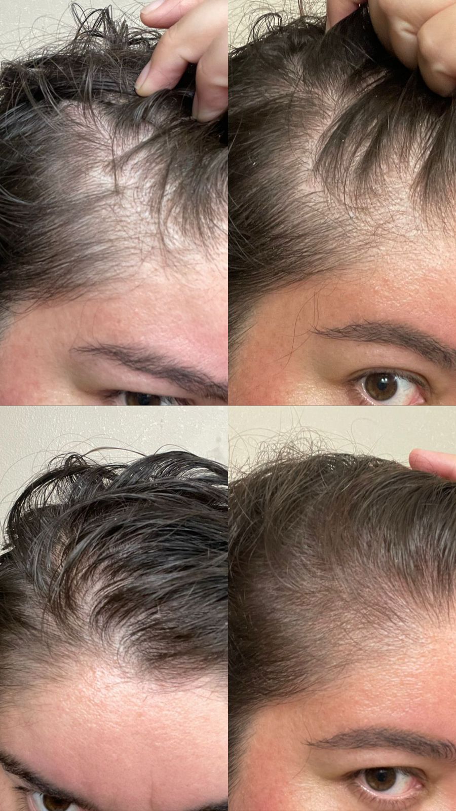 Cuero cabelludo sano sin irritación