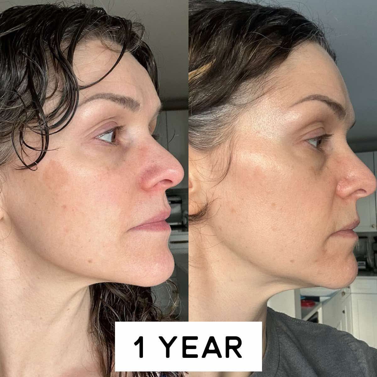 Antes y después de perfil con recuperación visible de acné severo.