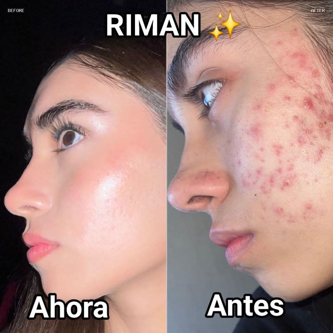 Antes y después de una rutina RIMAN con mejora visible de acné en perfil.