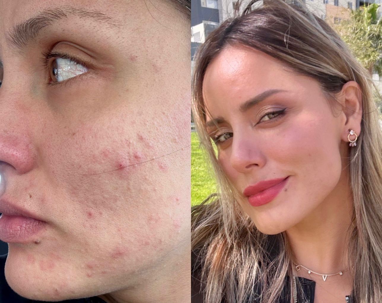 Antes y después de piel con acné adolescente y mejora visible.