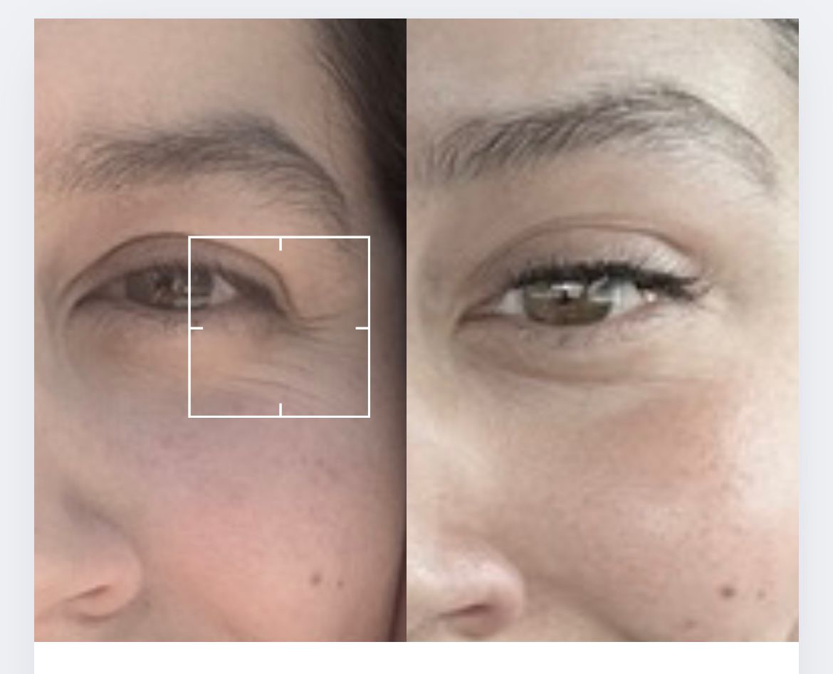 Antes y después en primer plano de zona ocular con mejor uniformidad.