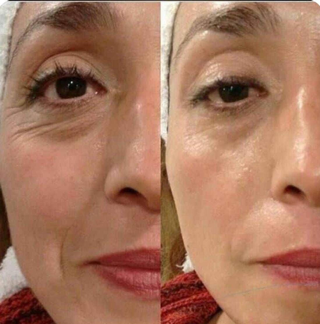 Antes y después de la zona de ojos con apariencia más lisa y levantada.