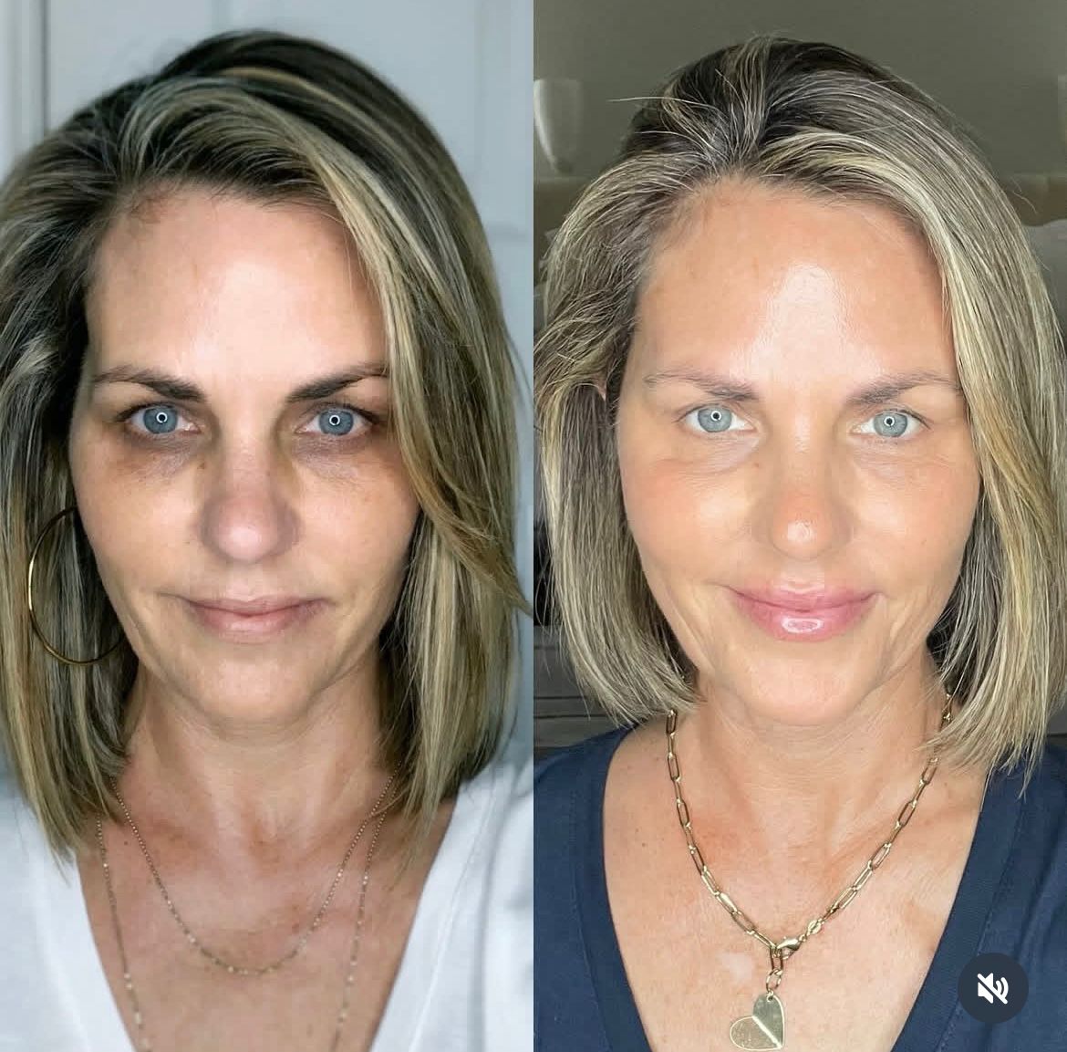 Antes y después frontal con apariencia facial más fresca y uniforme.