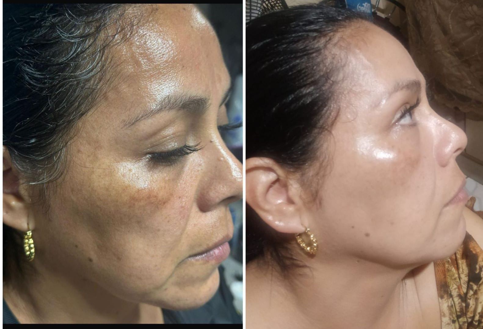 Antes y después de piel madura con mayor luminosidad y textura más uniforme.