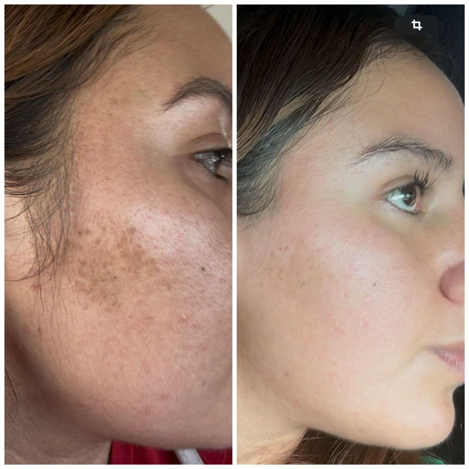 Antes y después de perfil con reducción visual de manchas en la piel.